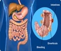 Diverticulosis and Diverticulitis                                                                                                                                                                       